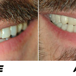 Before and after picture big smile