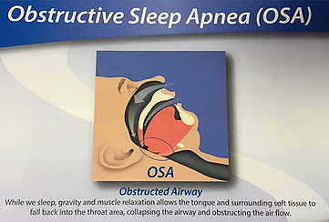 Sleep apnea and snoring example picture