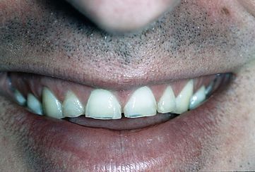 Teeth Grinding (Bruxism) night guards example
