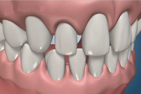 Porcelain Veneers